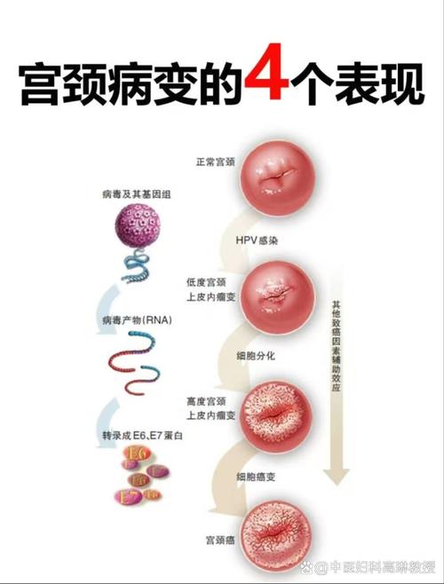 宫颈病变