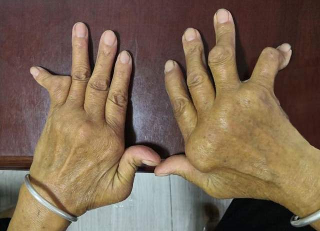  类风湿性关节炎