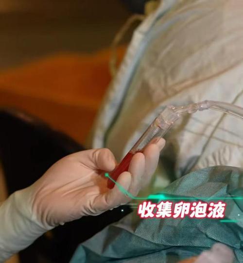 卵子采集