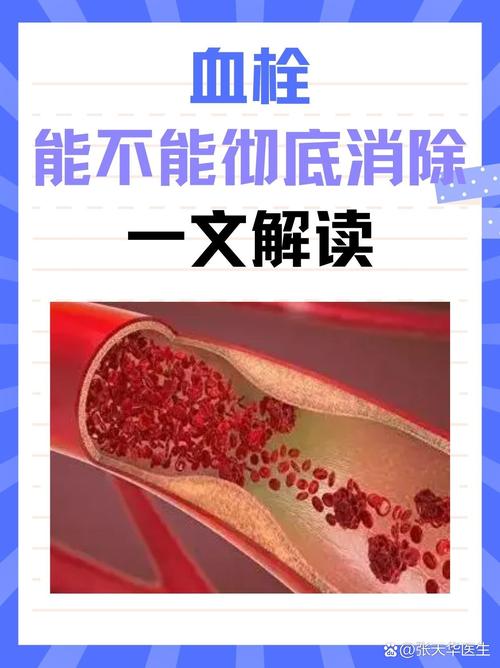 血栓形成