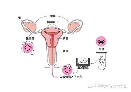  美国辅助生殖技术