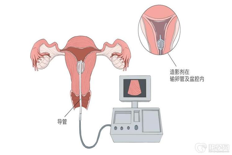 试管婴儿造影疼吗？全方位透析疼痛与体验