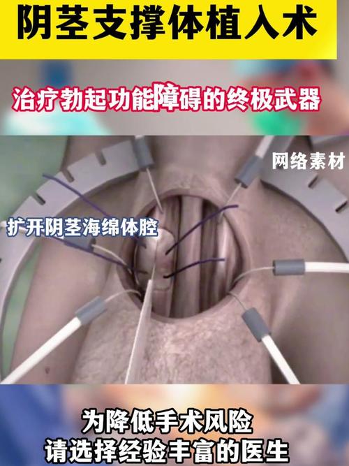 植入前步骤