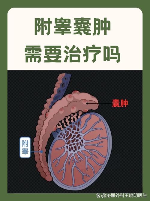 附睾头囊肿