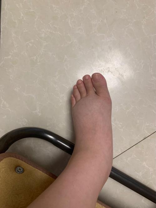 女性试管婴儿后为何会出现浮肿现象？