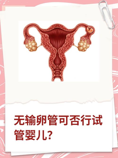 无输卵管