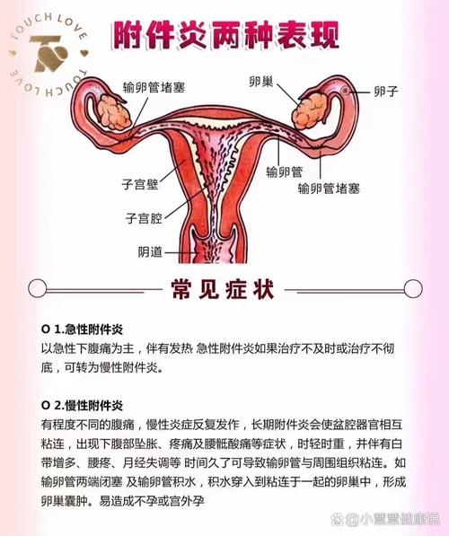 附件炎