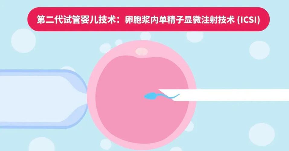 第二代试管婴儿技术