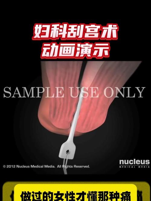 刮宫