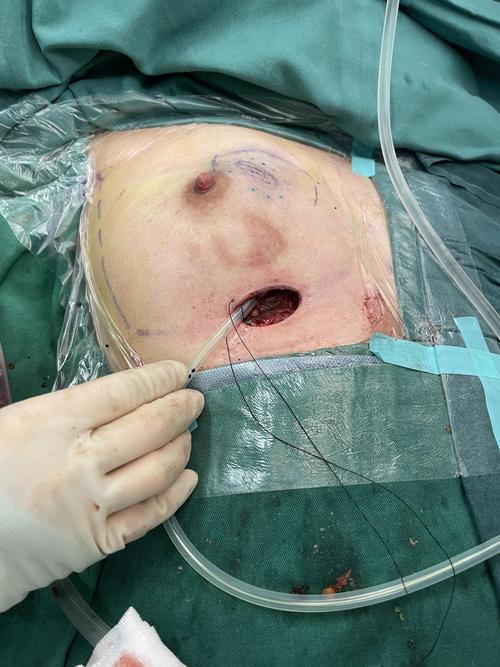 乳腺手术