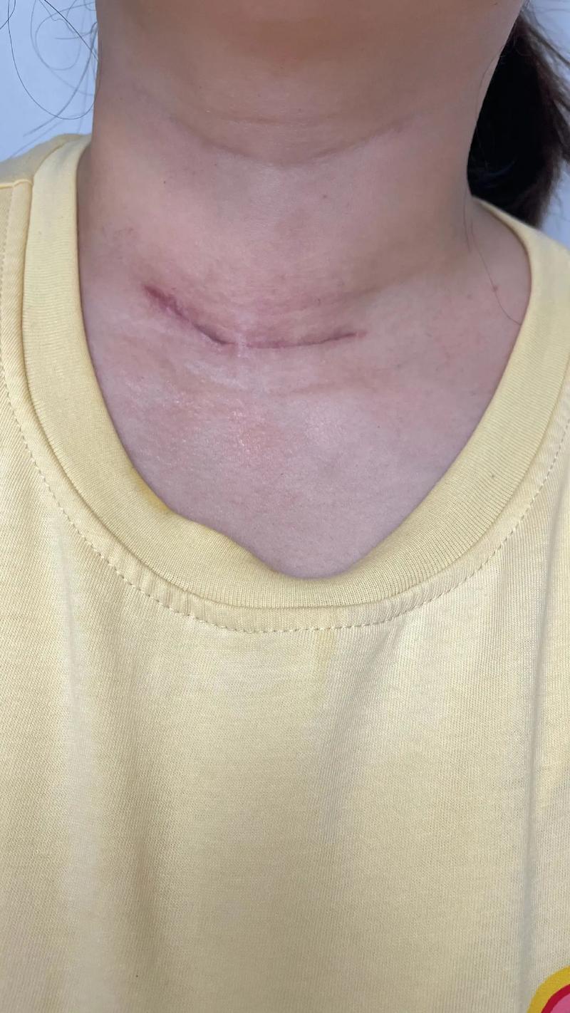 甲状腺结节