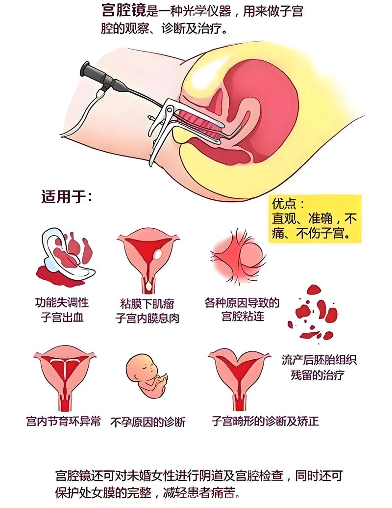  宫腔镜手术