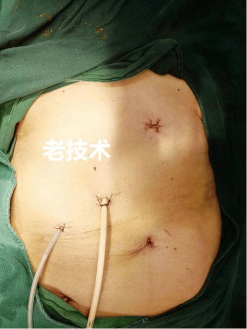 胆结石移植法