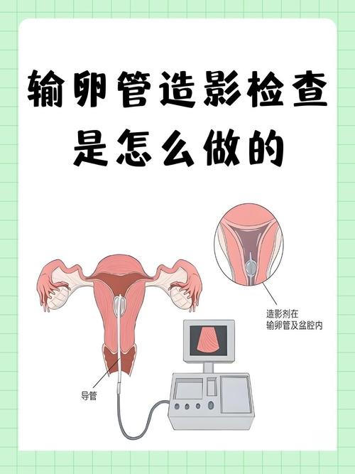  输卵管造影检查