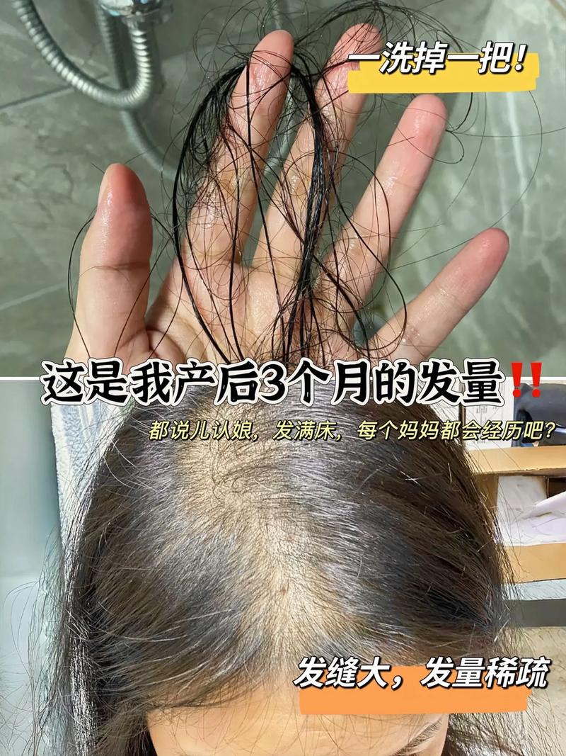 产妇脱发
