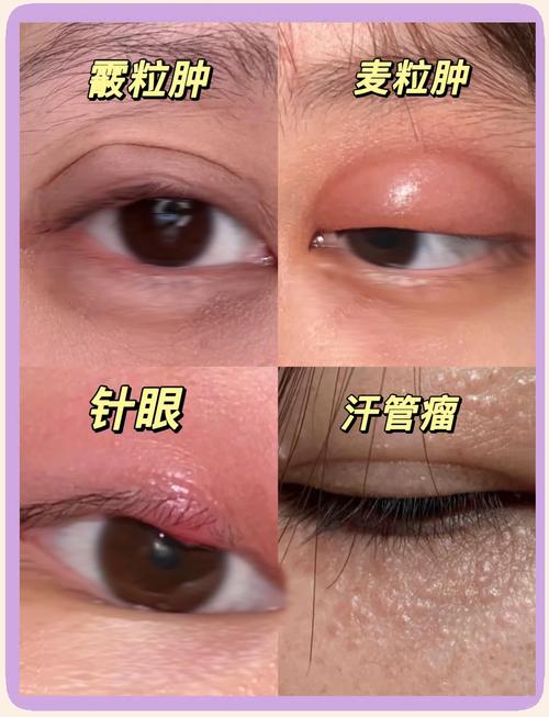 针眼图