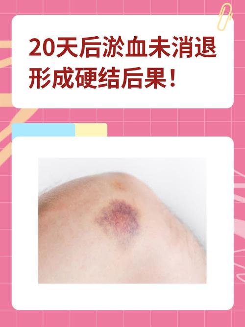 淤血内结症
