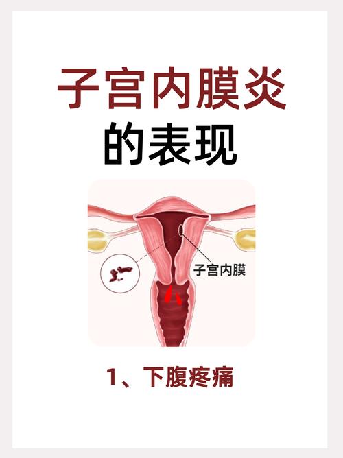 子宫内膜炎