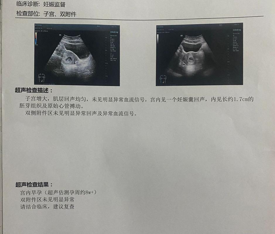 左侧宫角妊娠