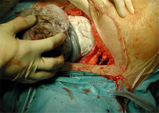  剖腹产