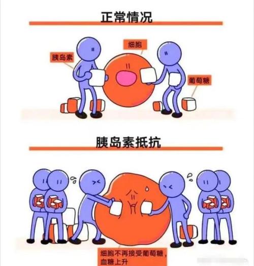 胰岛素抵抗