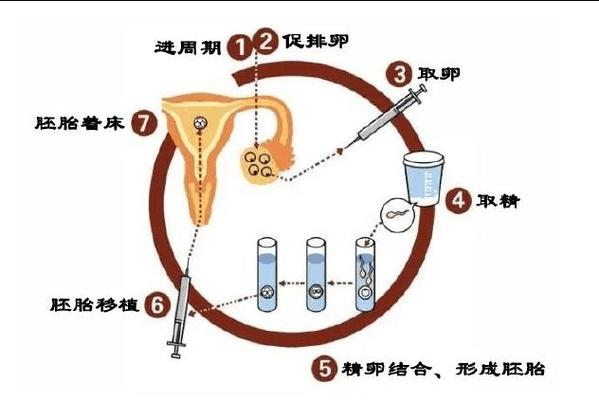 处女无需性经历也能进行试管婴儿吗？