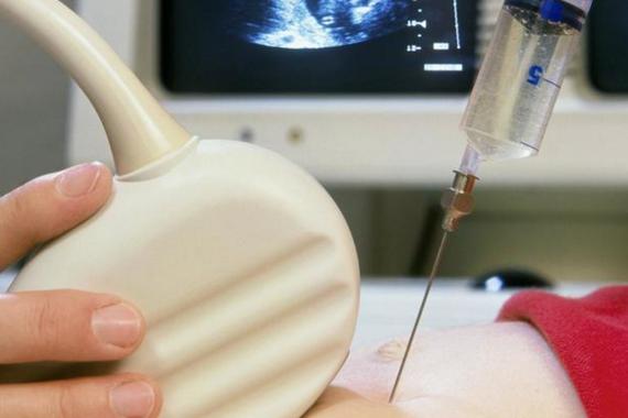 揭秘：试管婴儿是否必须进行羊水穿刺？