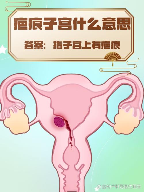 瘢痕子宫