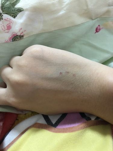 试管婴儿过程中针眼处理技巧与注意事项解析