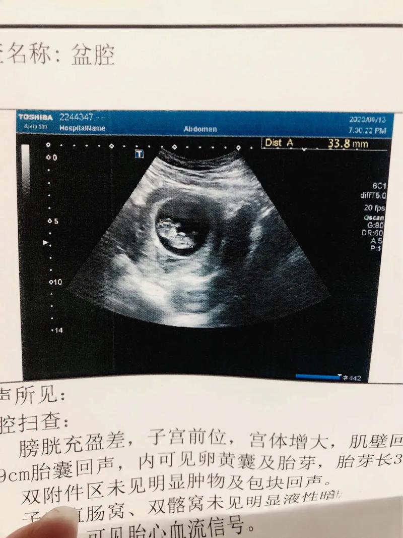 怀孕10周