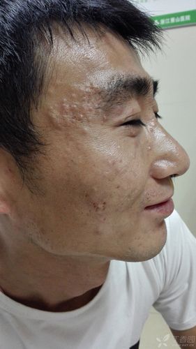 狼疮患者