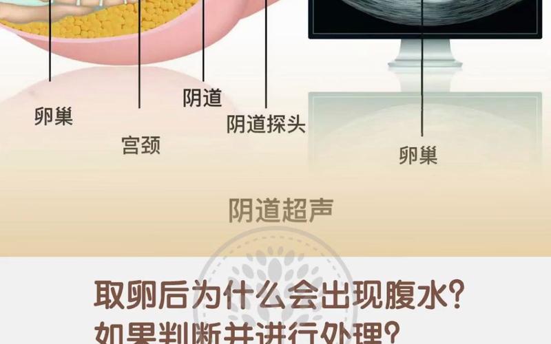 试管婴儿后腹水产生的原因与应对措施分析