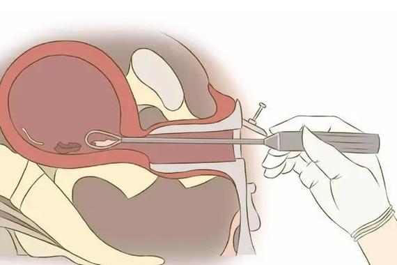 试管婴儿刮宫前的诊断真的有必要吗？