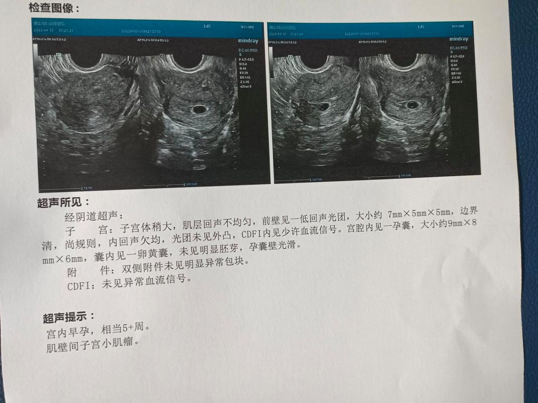 试管婴儿移植孕囊小，有哪些需要注意的？