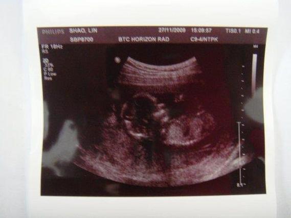 试管婴儿胎位通常较低吗？有什么影响？