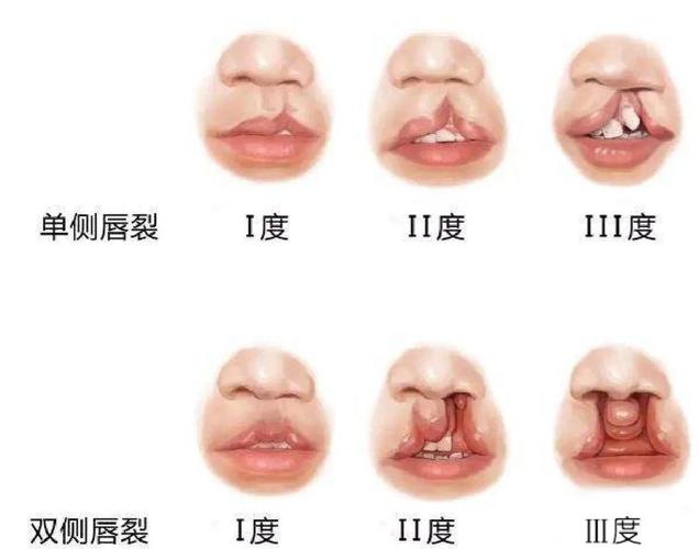 兔唇