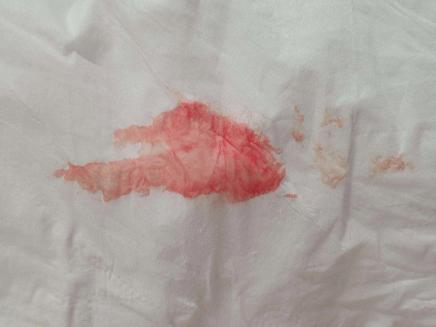 试管婴儿移植10天后见红：这意味着什么？