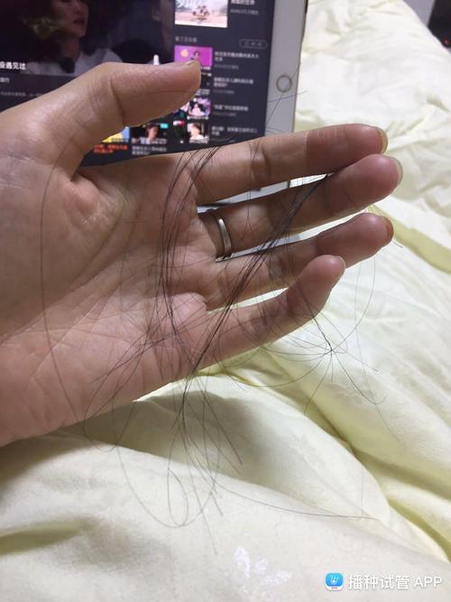 对于脱发的顾虑，试管婴儿是不是好选择？