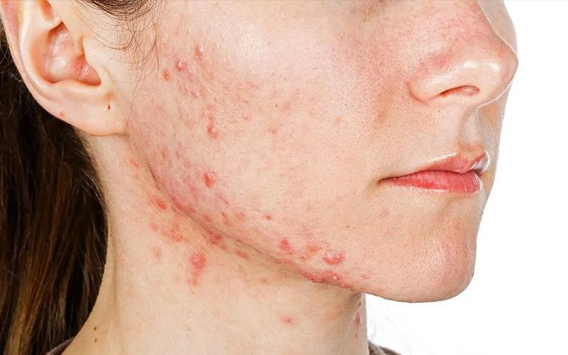 试管婴儿成功后，为何我总是长痘痘？