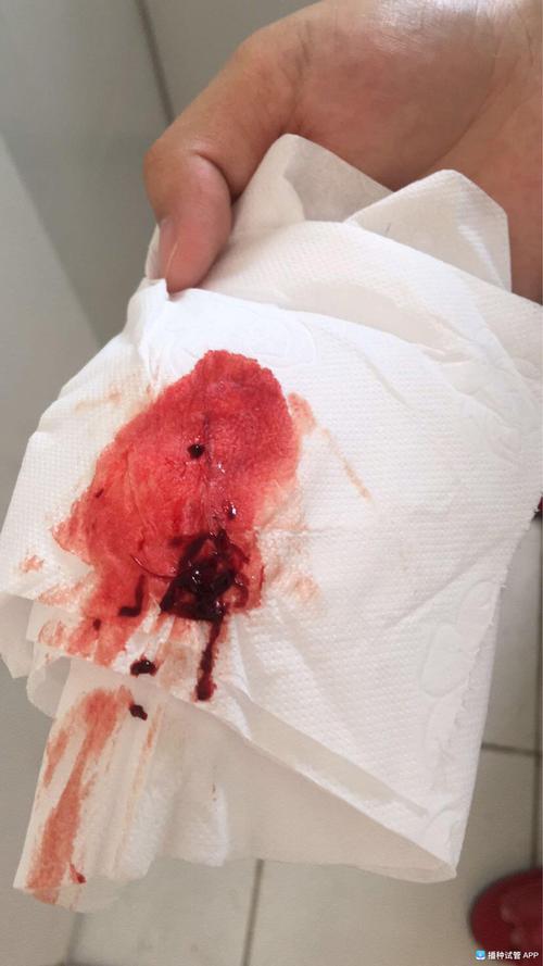 试管婴儿两周后有血迹：我该担心吗？