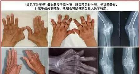 试管婴儿如何规避类风湿性关节炎遗传风险？