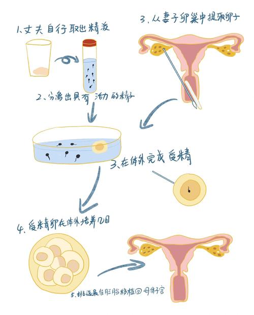 巧囊症能否进行试管婴儿治疗？详解与解析