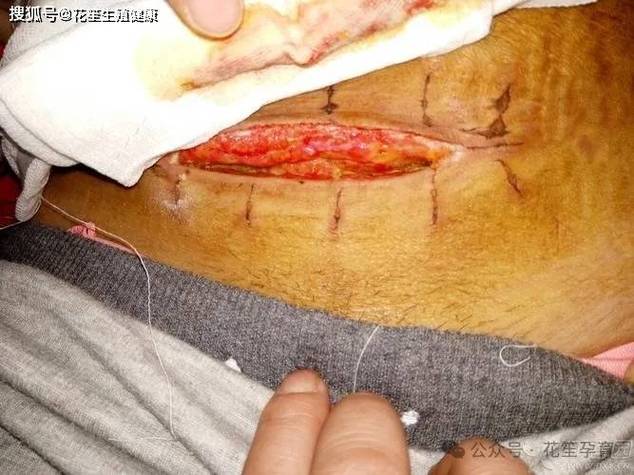 剖腹产后能不能做试管婴儿？答案揭晓！